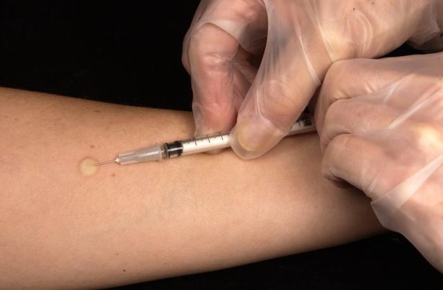 Image:Mantoux tuberculin skin test.jpg