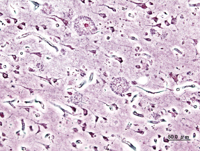 Image:Alzheimer dementia (3) presenile onset.jpg