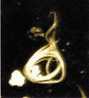Microscopy image of a neurofibrilary tangle, conformed by hyperphosphorylated tau protein.