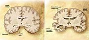 Comparison of a normal aged brain (left) and an Alzheimer's patient's brain (right). Differential characteristics are pointed out