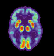 PET scan of the brain of a person with AD showing a loss of function in the temporal lobe. Neuroimaging is being increasingly used to diagnose Alzheimer's.
