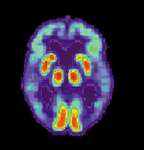 Image:PET Alzheimer.jpg