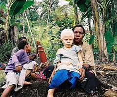 Albinistic girl from Papua New Guinea