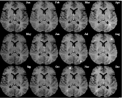 T1-weighted MRI scans (post-contrast) of same brain slice at monthly intervals. Bright spots indicate active lesions.