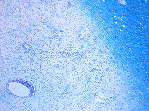 Demyelinization in MS. On Klüver-Barrera myelin staining, decoloration in the area of the lesion can be appreciated (Original scale 1:100).