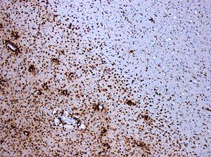 Demyelinization in MS. Immunohistochemstry for CD68 demonstrates Macrophages (brown) in the area of the lesion(Original scale 1:100).