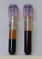 Two tubes of EDTA anticoagulated blood.Left tube: after standing, the RBCs have settled at the bottom of the tube.Right tube: contains freshly drawn blood.