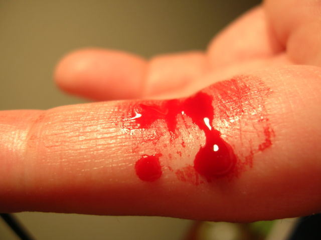 Image:Bleeding finger.jpg