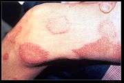 Cutaneous leprosy lesions on a patient's thigh.