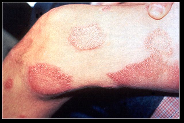 Image:Leprosy thigh demarcated cutaneous lesions.jpg