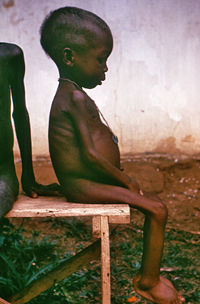 A starving female child during the Nigerian-Biafran war of the late 1960s. The abdomen is paradoxically swollen due to Kwashiorkor or severe protein malnutrition.