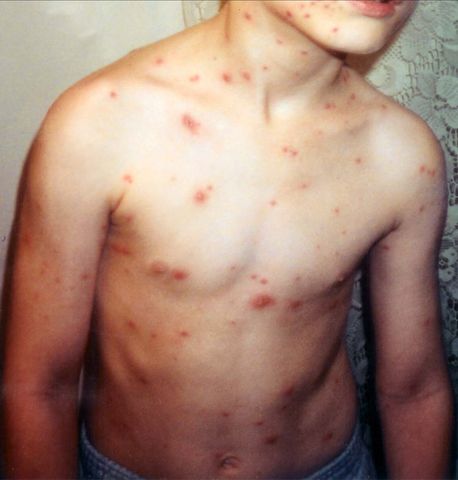 Image:Child with chickenpox.jpg