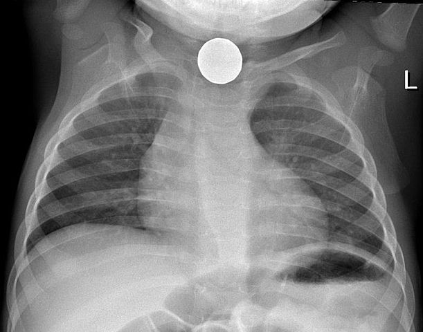 Image:Coin in esophagus 2.jpg