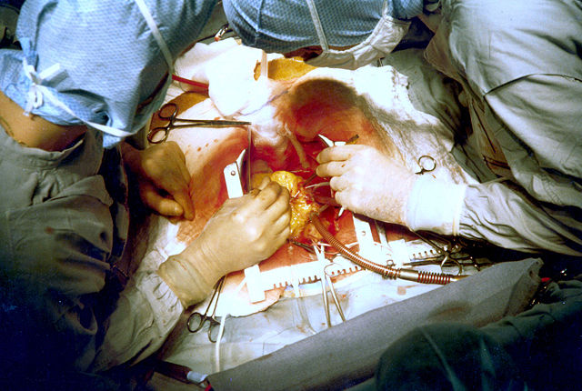 Image:Coronary artery bypass surgery Image 657B-PH.jpg