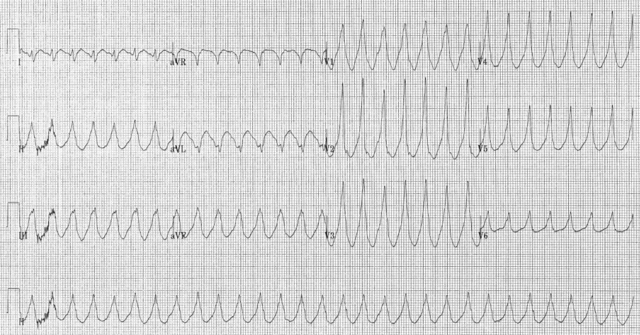 Image:Electrocardiogram of Ventricular Tachycardia.png