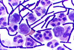 Bacillus anthracis (stained purple) growing in cerebrospinal fluid