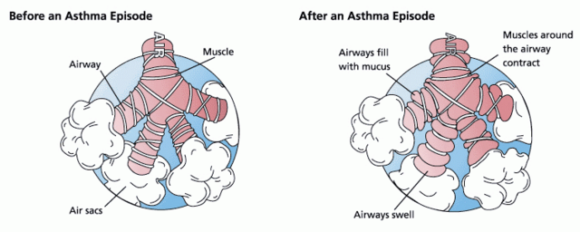 Image:Asthma before-after.png