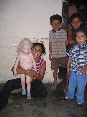 Image:Albino girl honduras.jpg