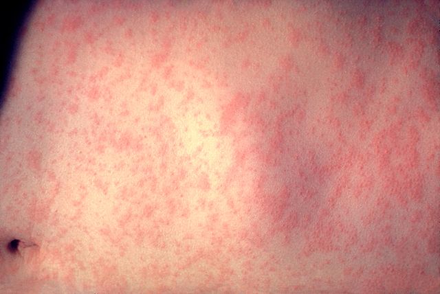 Image:Morbillivirus measles infection.jpg