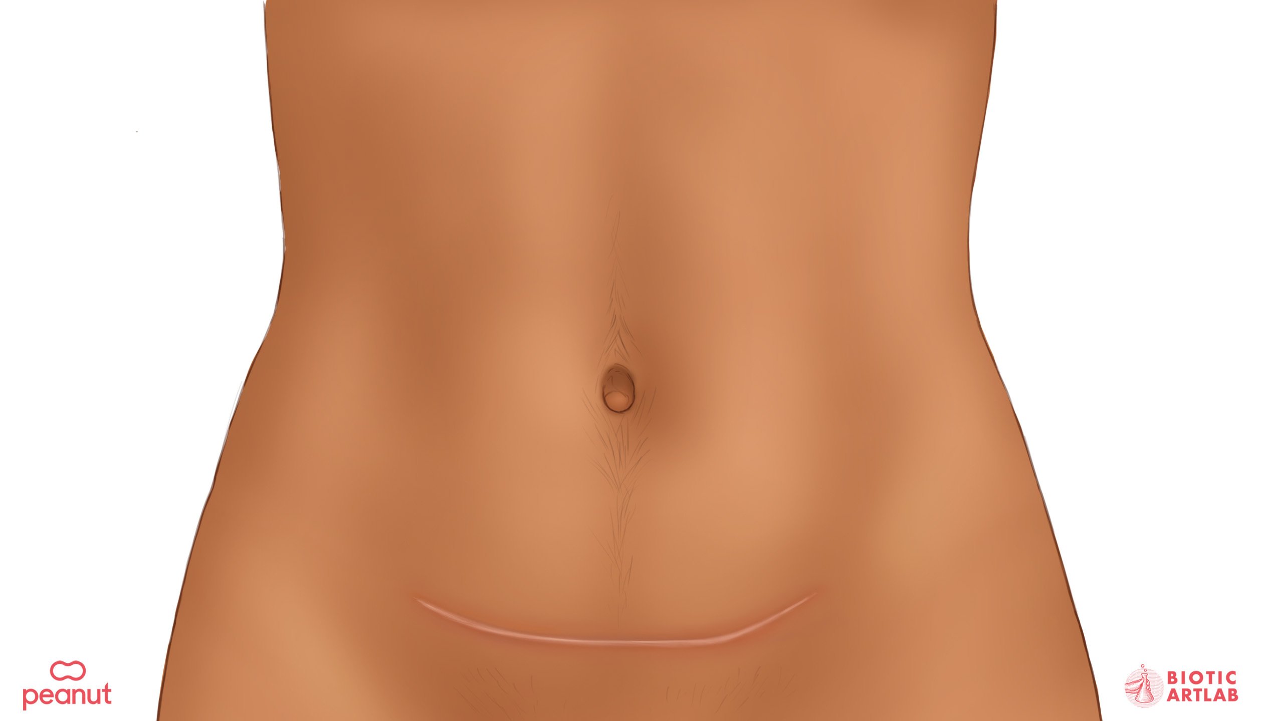 An image of a torso and stomach after a C-section birth.