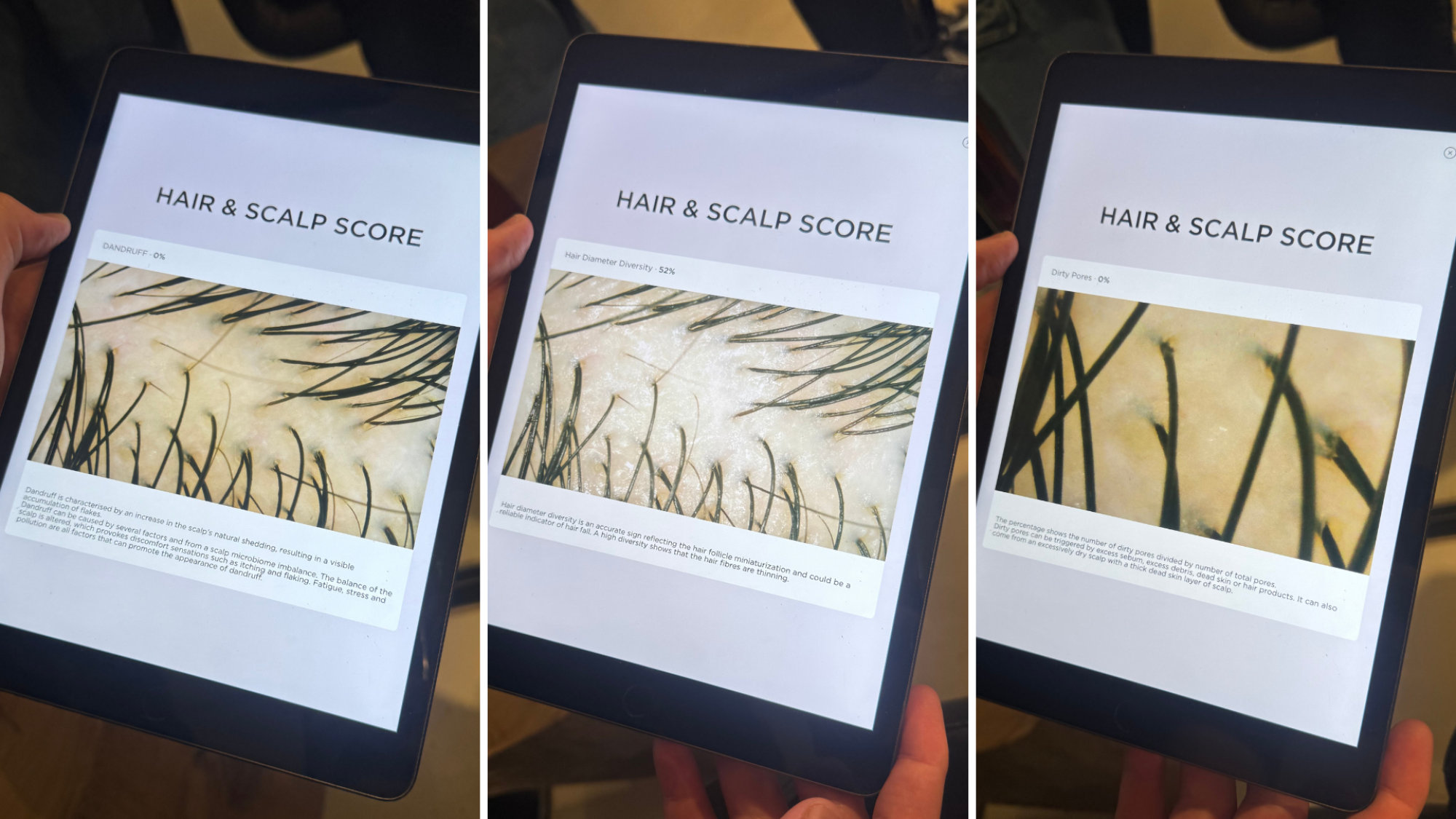 Three photos of K-SCAN results on a tablet measuring dandruff, hair diameter diversity, and dirty pores.