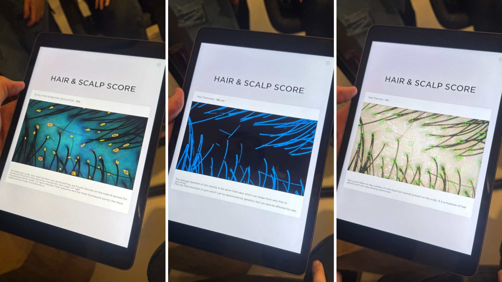 Three photos of K-SCAN results on a tablet, showing a scalp microbiome indicator, hair diameter, and hair density.